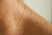 FDA warns Amazon, different distributors about sale of pores and skin tag removing merchandise