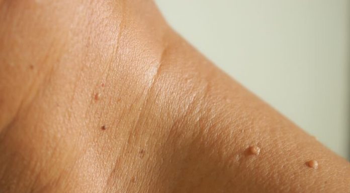 FDA warns Amazon, different distributors about sale of pores and skin tag removing merchandise