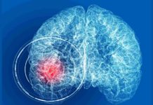 Mind aneurysm: 5 issues to learn about this well being subject