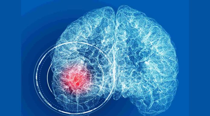 Mind aneurysm: 5 issues to learn about this well being subject