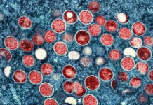 Consultants focus on monkeypox signs, unfold