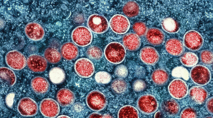 Consultants focus on monkeypox signs, unfold