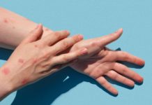 Monkeypox rash: Know all about its signs and prevention