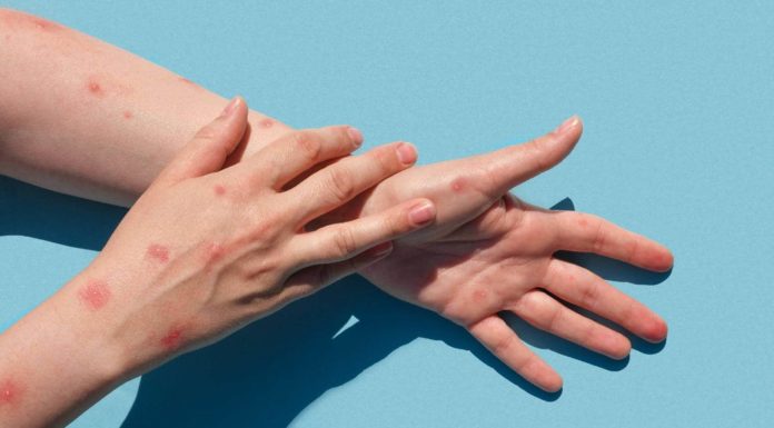 Monkeypox rash: Know all about its signs and prevention