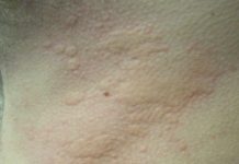 What causes hives and the way harmful can they be? A nurse practitioner explains
