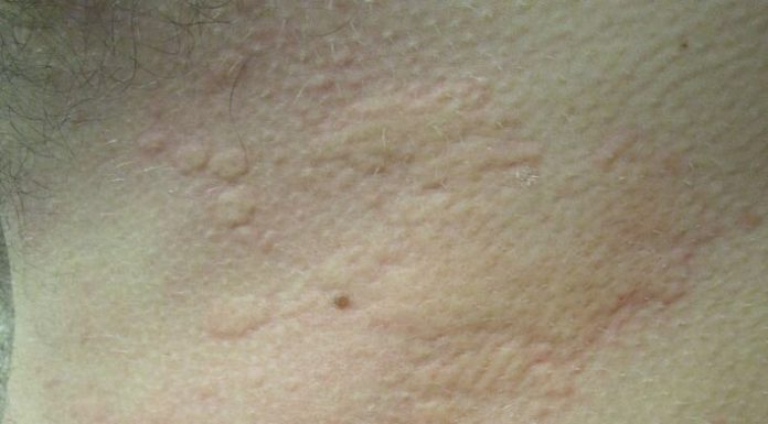 What causes hives and the way harmful can they be? A nurse practitioner explains