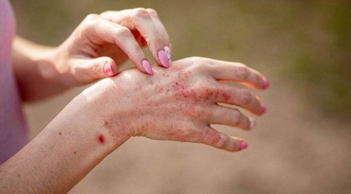 Atopic dermatitis: 5 myths busted by a dermatologist
