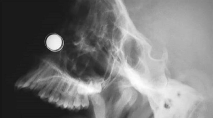 Feds tighten security requirements on tiny high-powered magnets which have injured youngsters