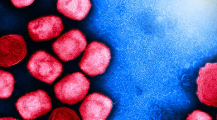 Amid HIV/AIDS connection, worry of racial disparities for monkeypox grows