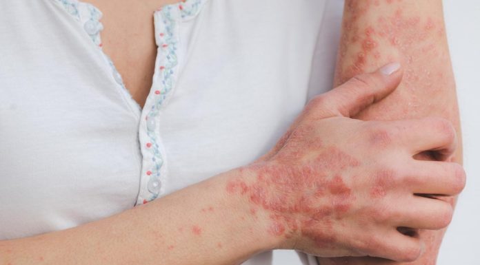 Psoriasis diagnoses in major care could also be delayed by as much as 5 years