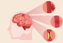 World Stroke Day: Know signs, danger elements and remedy of strokes