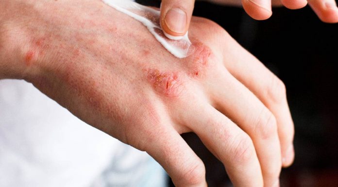 Psoriasis and psychological well being: Understand how this pores and skin illness is linked to emphasize