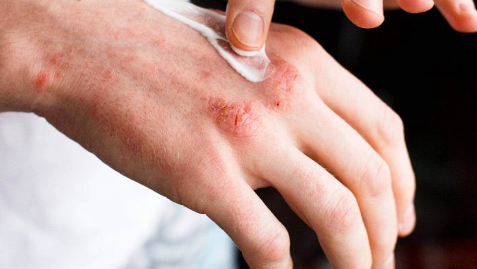 psoriasis.jpg