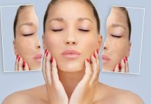 Know unwanted side effects of bleaching for pores and skin and hair