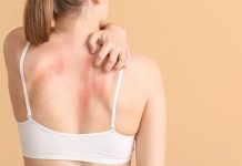 7 residence cures to deal with jock itch