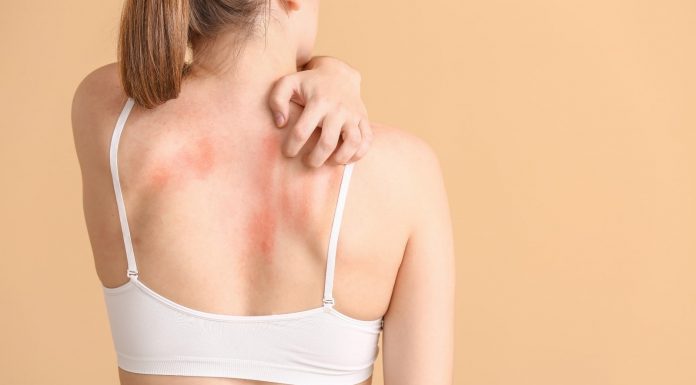 7 residence cures to deal with jock itch