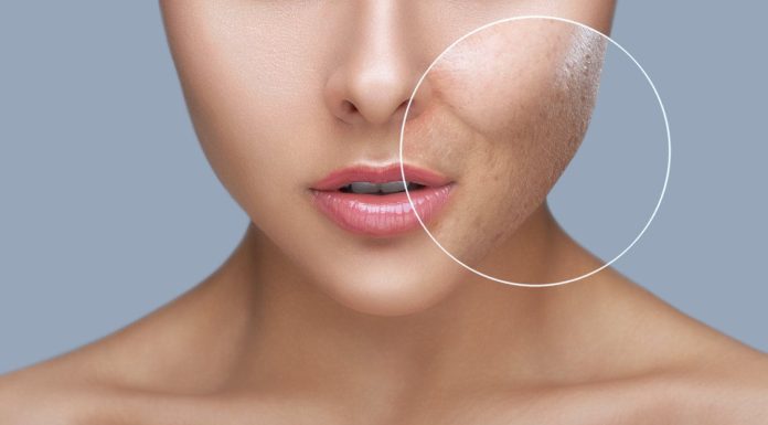 Cut back pore measurement for pimples free pores and skin with these 5 ideas
