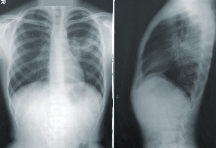 pneumonia.jpg
