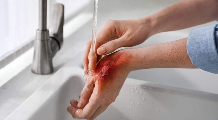 First support for pores and skin: How you can deal with cuts, burns and fungal infections