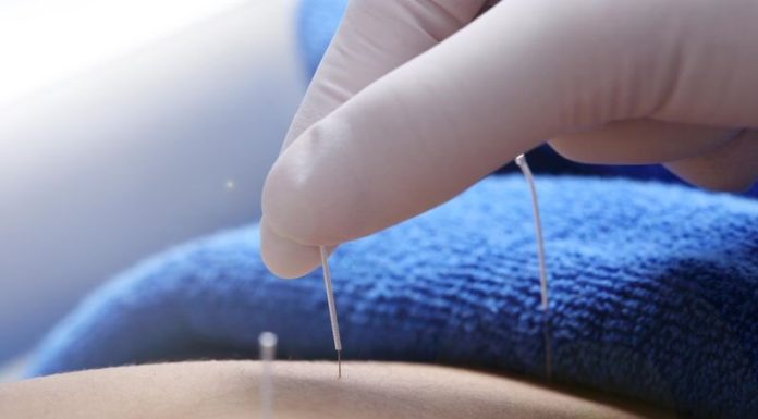 Acupuncture could help irritable bowel syndrome with diarrhea