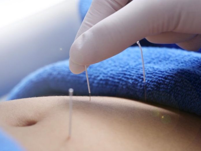 acupuncture-may-aid-ir.jpg