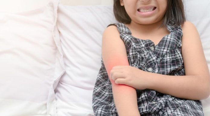Atopic dermatitis raises subsequent fracture threat in kids: Research