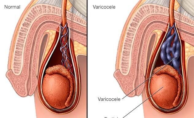 Enlarged veins may cause ache, infertility