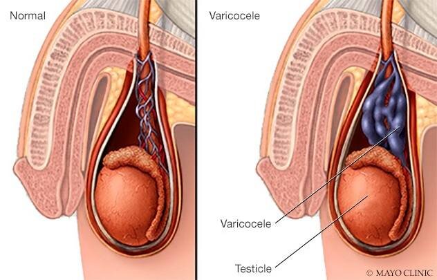 enlarged-veins-can-cau.jpg