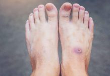 Understanding the hyperlink between diabetes and wound therapeutic