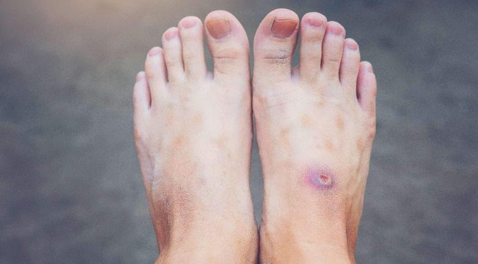 Understanding the hyperlink between diabetes and wound therapeutic