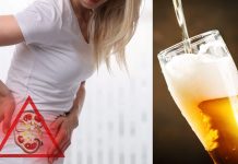 Beer for kidney stones: Is it secure or not?