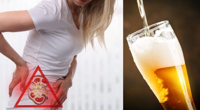 Beer for kidney stones: Is it secure or not?