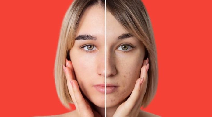 The way to deal with clogged pores in winter? 5 tricks to clear them