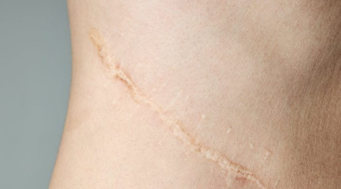 The best way to deal with scars at residence—and hopefully make them disappear