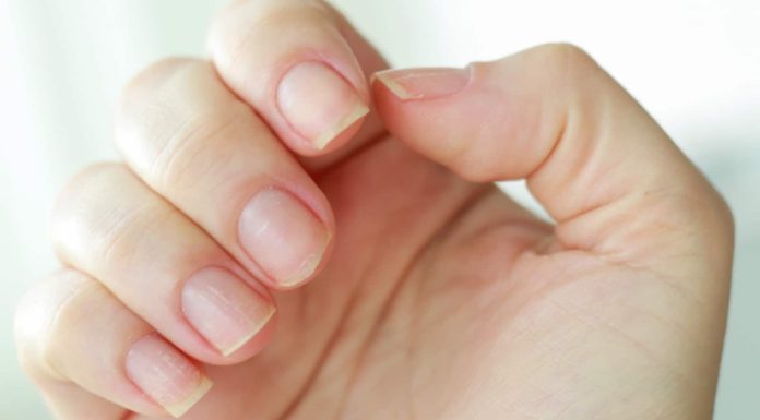 How you can clear yellow nails? Observe these 7 nail care ideas