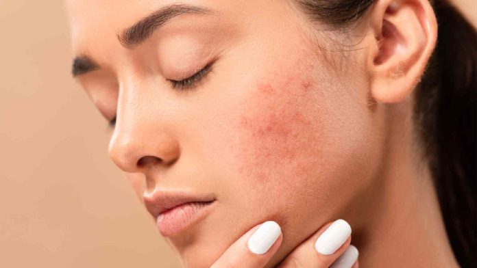 acne-1.jpg
