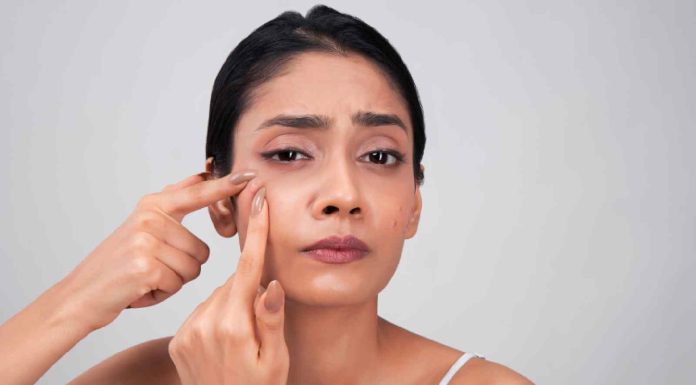 Brides, this is how one can keep away from pimples breakout