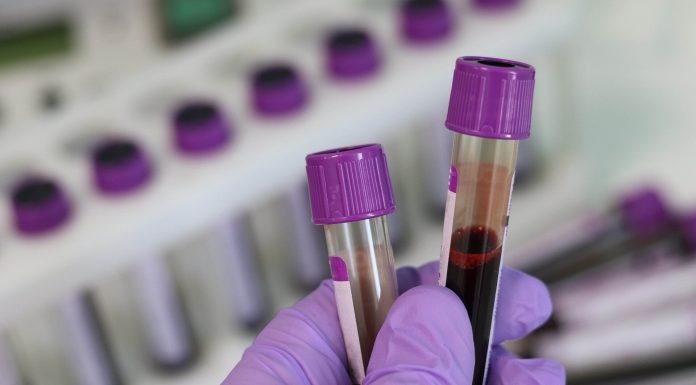 By no means had a lipid panel? Here is why it is necessary