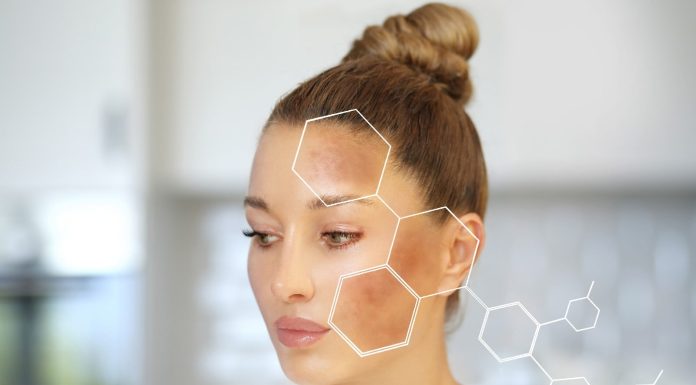 The way to handle hyperpigmentation throughout winter? 3 tricks to observe