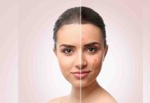 DIY skincare: 5 home made face packs for acne-prone pores and skin