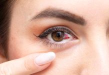 Subconjunctival hemorrhage: What a damaged blood vessel in eye means
