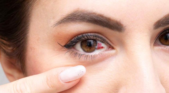 Subconjunctival hemorrhage: What a damaged blood vessel in eye means