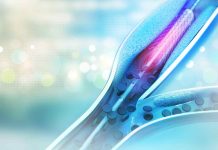 Understanding angioplasty and stents: What you’ll want to know