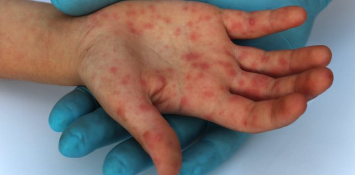 measles-has-been-ident.jpg
