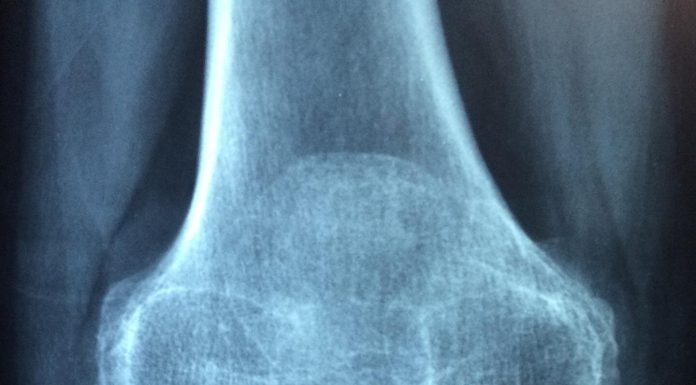 Often called the silent illness, osteoporosis impacts 10 million individuals within the US