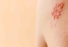 Shingles: Know myths vs info about this viral an infection