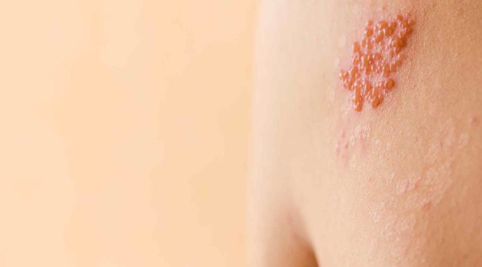 Shingles: Know myths vs info about this viral an infection