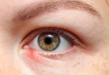 What causes a stye, dangers and how will you deal with and forestall