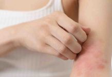 Warmth rash remedy: Attempt the cooling advantages of coconut oil