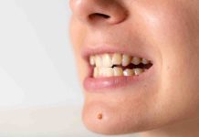 Free enamel in adults: Discover the trigger and methods to repair it